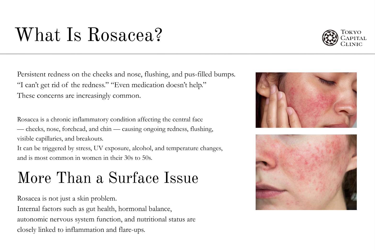 glutathione rosacea Low glutathione is something I see often in clients dealing with skin  issues. Without optimal glutathione levels, your body and skin struggle to  properly handle pathogens, toxins, and heavy metals, while also